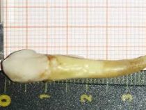Пациенту удалили самый длинный зуб в мире
