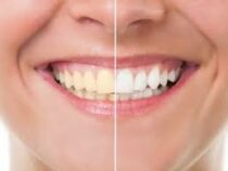 Специалисты назвали топ-5 продуктов, от которых портятся зубы