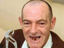 Британский пенсионер удалил себе 11 зубов при помощи плоскогубцев