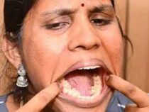 Индианка с 38 зубами установила мировой рекорд